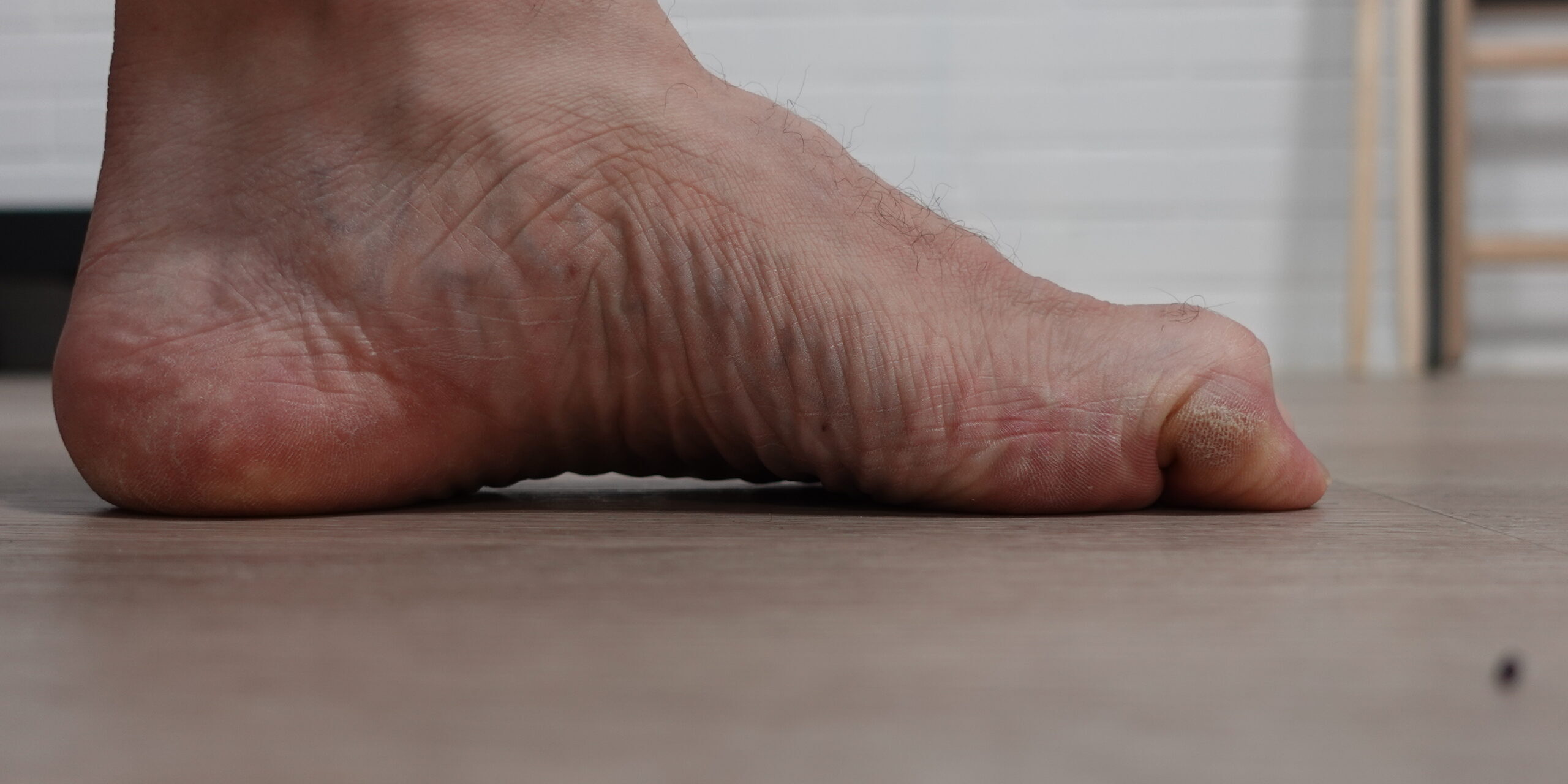 ukipohjalliset Joensuussa – päkiän kivun ja varvasmuutosten helpottajana Jalan sisäsyrjä, jossa isovarvas on vasaravarvasasennossa – kuva havainnollistaa, miten päkiän kipu ja varvasmuutokset liittyvät kuormituksen epätasapainoon ja miten tukipohjalliset voivat auttaa.