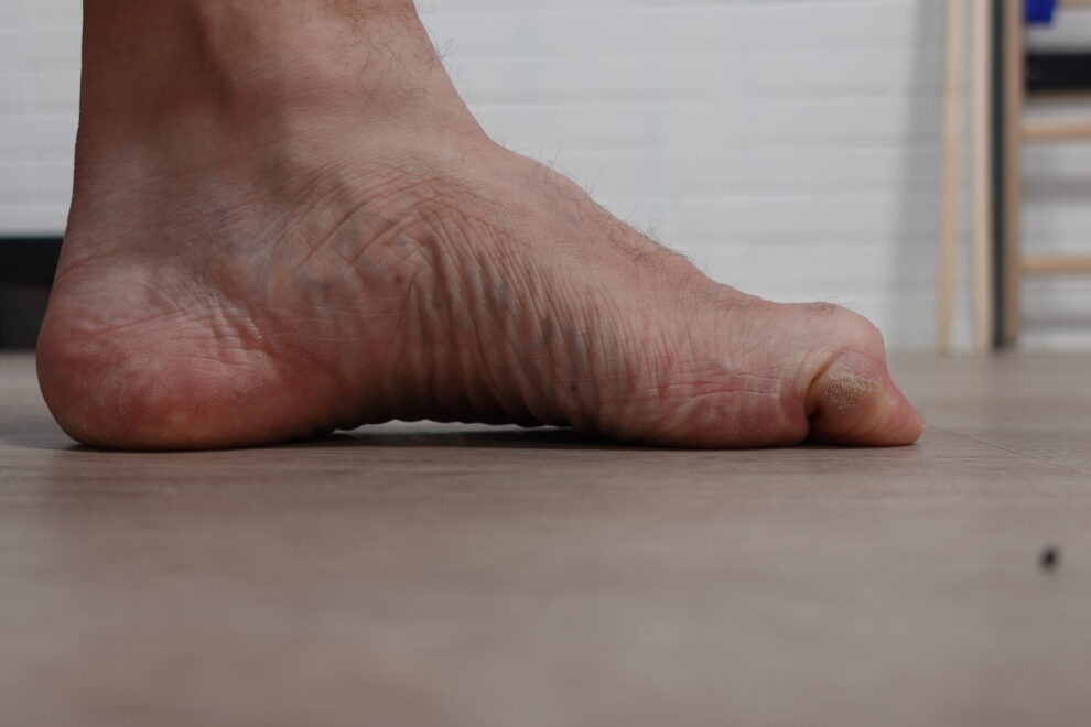 Jalan sisäsyrjä, jossa isovarvas on vasaravarvasasennossa – kuva havainnollistaa, miten päkiän kipu ja varvasmuutokset liittyvät kuormituksen epätasapainoon ja miten tukipohjalliset voivat auttaa.