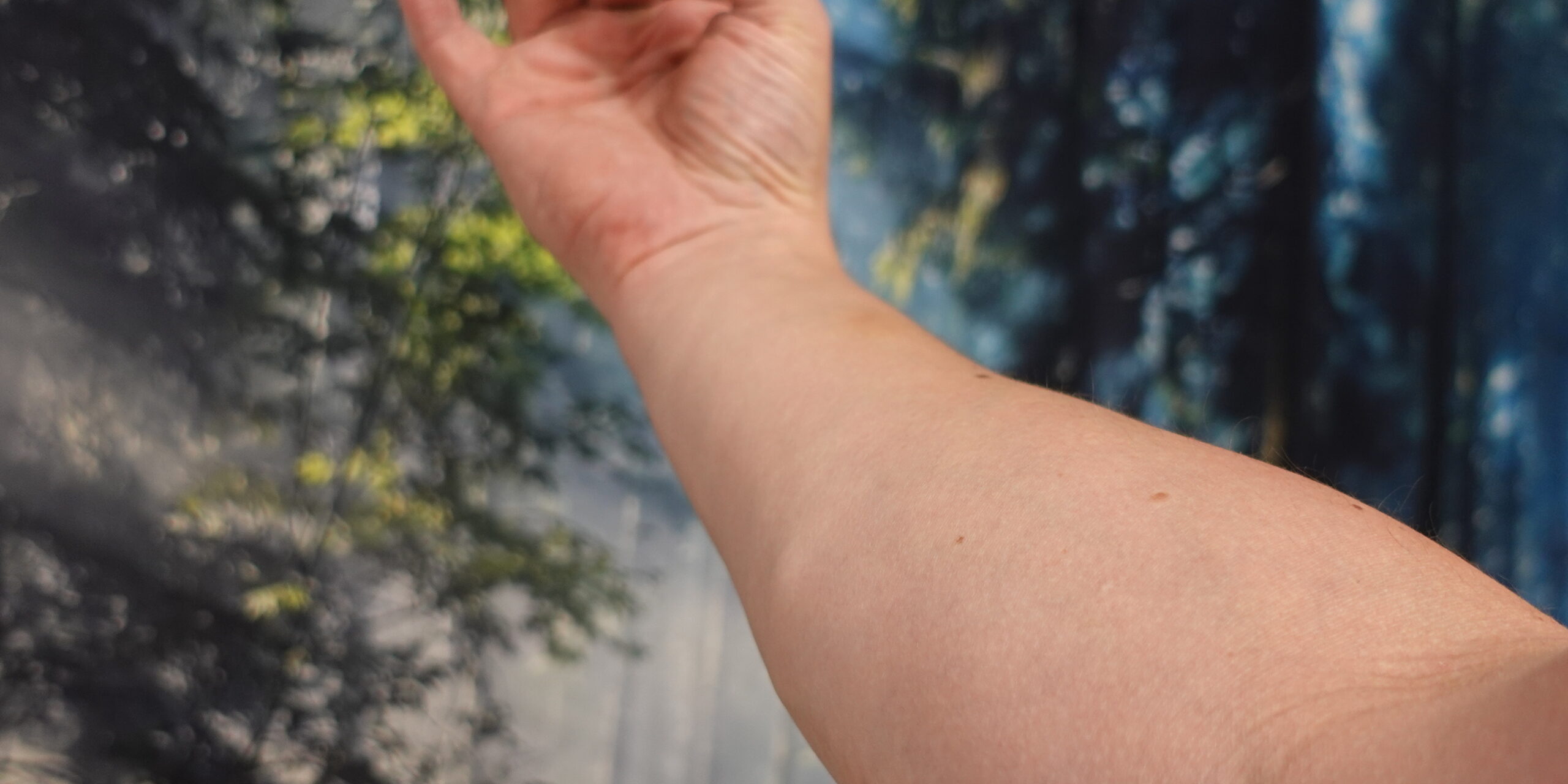 Käsi kuvattuna kyynärvarresta, ranne lievästi koukussa “italialaisessa” asennossa. Kuvassa näkyy alue, jossa rannekanavaoireyhtymän kipu ja puutuminen usein tuntuvat.