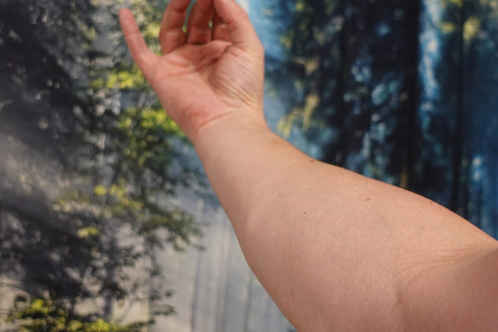 Käsi kuvattuna kyynärvarresta, ranne lievästi koukussa “italialaisessa” asennossa. Kuvassa näkyy alue, jossa rannekanavaoireyhtymän kipu ja puutuminen usein tuntuvat.