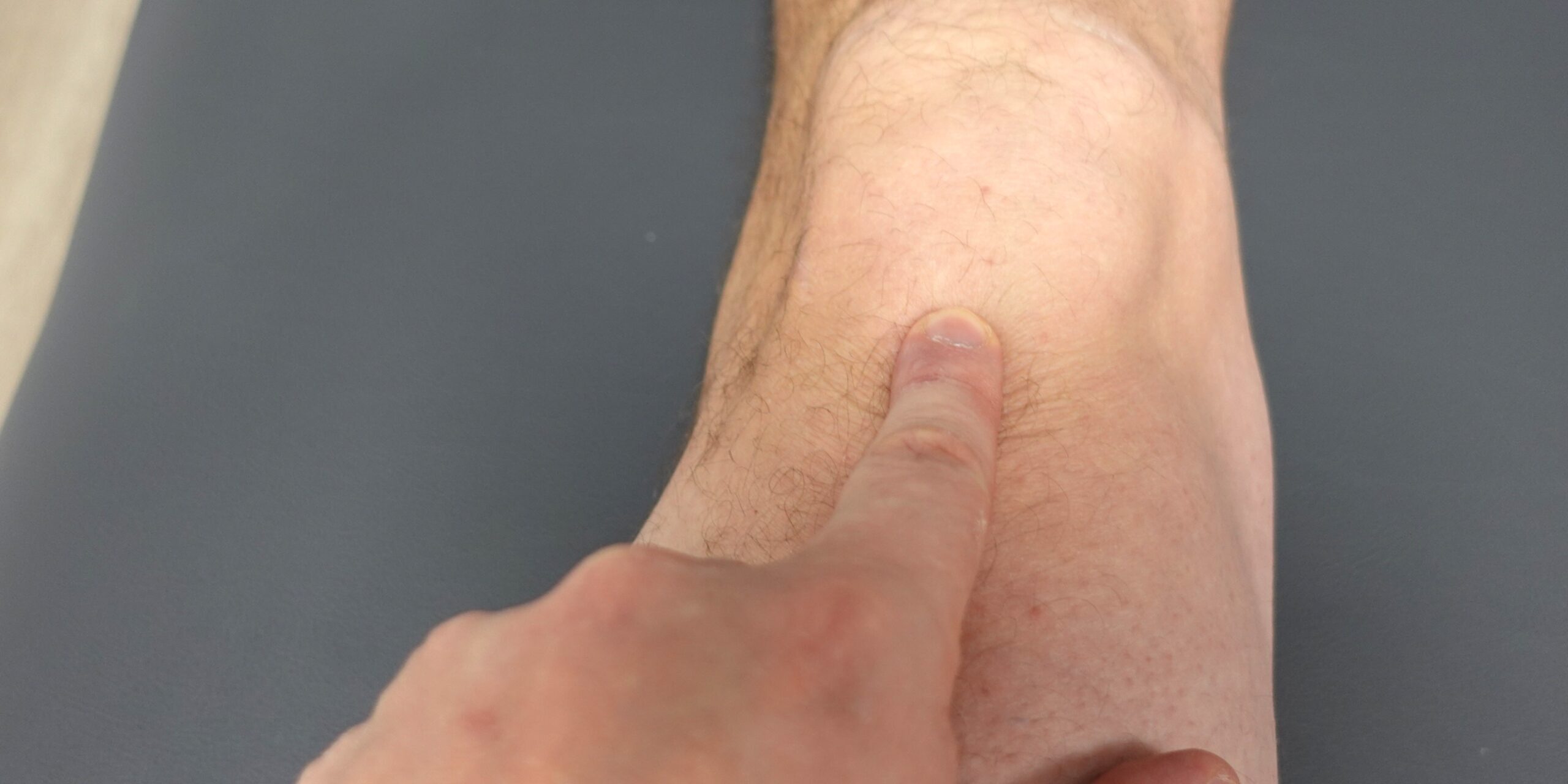 Patellofemoraalinen kipu polven etuosassa Patellofemoraalinen kipu tuntuu polven etuosassa kuormituksessa