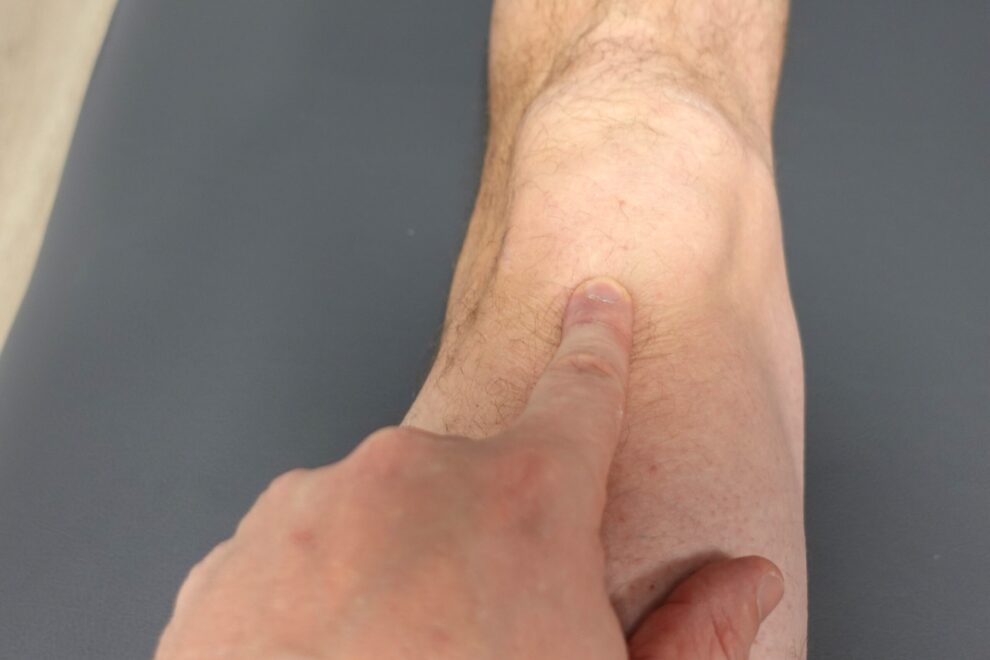 Patellofemoraalinen kipu tuntuu polven etuosassa kuormituksessa