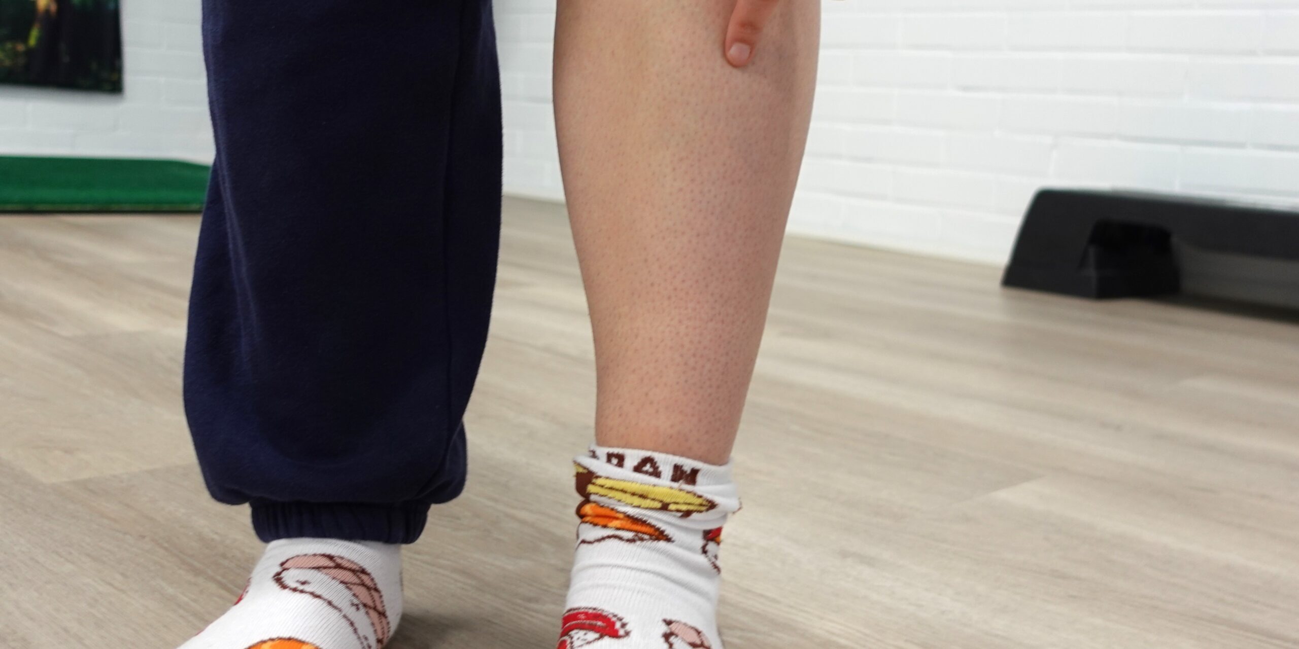 Penikkatauti – kipu sääressä Säären sisäsyrjän kipukohta penikkataudissa (medial tibial stress syndrome)