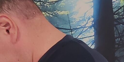 Kaularangan äärifleksio havainnollistamassa niskan retkahdusvamman liikesuuntaa Lähikuva niskasta sivusta äärifleksiossa havainnollistamassa kaularangan liikesuuntaa joka kuormittuu whiplash eli niskan retkahdusvammassa Reijolan Fysioterapiassa Joensuussa