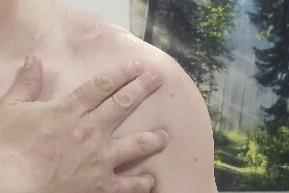 Lähikuva olkapäästä jossa sormi osoittaa AC-nivelen sijaintia solisluun ja lapaluun harjantteen välissä Reijolan Fysioterapiassa Joensuussa